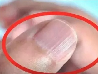 微量元素分析儀廠家分析手指甲有豎紋的根本原因 微量元素分析儀廠家分析手指甲有豎紋的根本原因